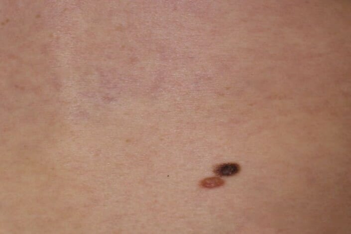 Scc Squamous Cell Carcinoma South East Skin Clinic